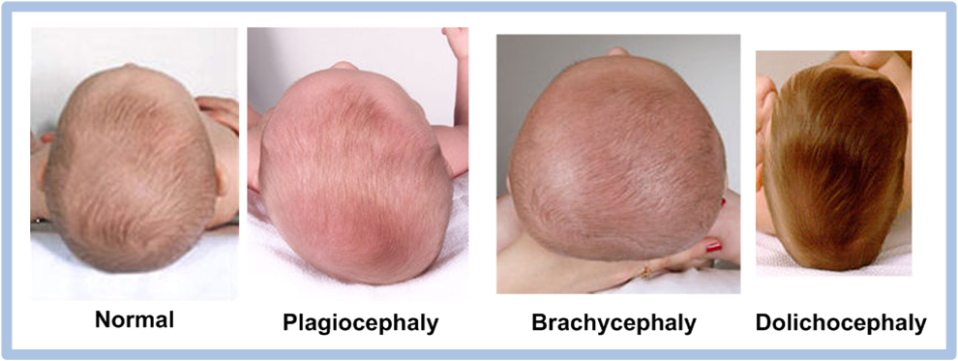 Incidence and Prevention of Baby Flat Head Syndrome | Baby Flat Head  Awareness and Prevention